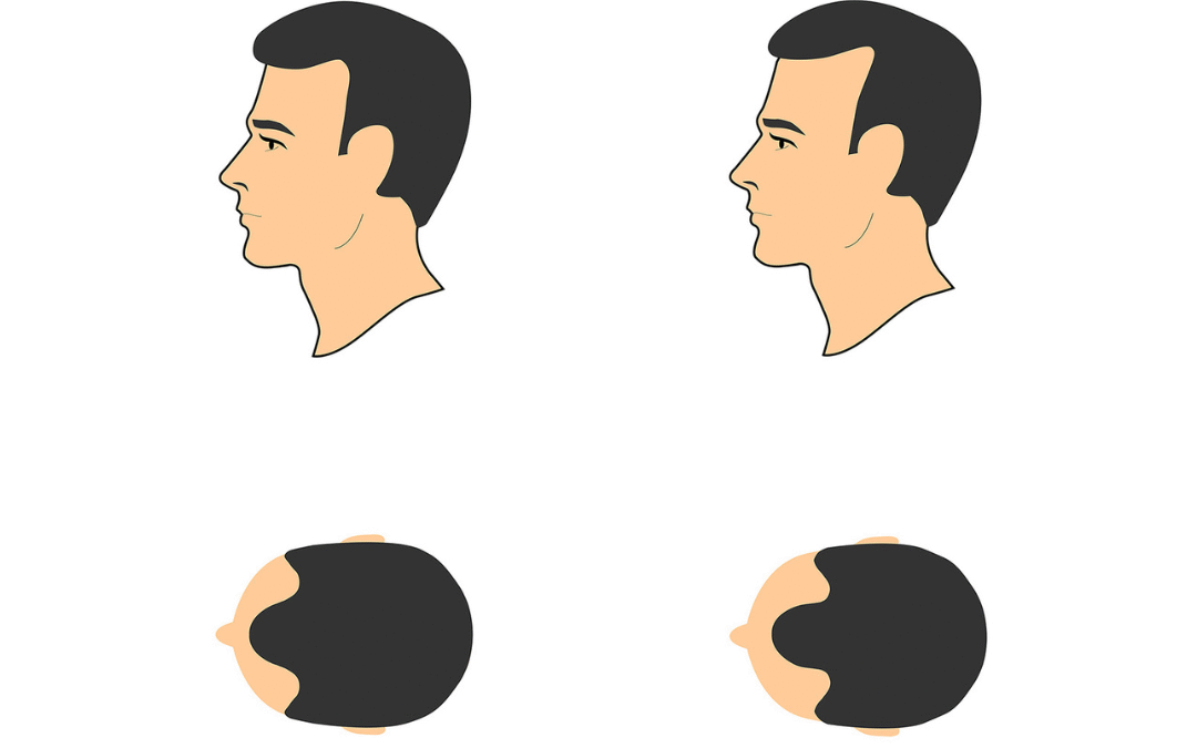 Stage Two Hairline and Density Boost